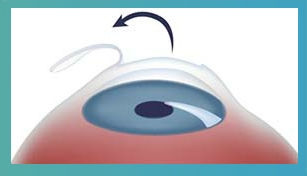 Операция на глаза близорукость вологда