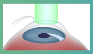 Операция на глаза близорукость вологда